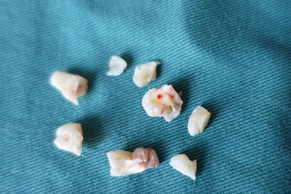 牙齿脱敏凝胶的作用与功效及副作用有哪些药(牙齿脱敏凝胶的作