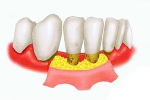 年纪轻牙龈萎缩怎么办呢(年纪轻牙龈