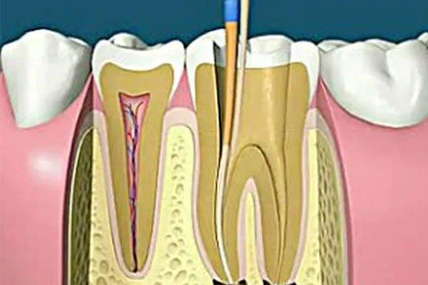 做根管治疗的价格是多少(做根管治疗的价格是多少钱一颗)