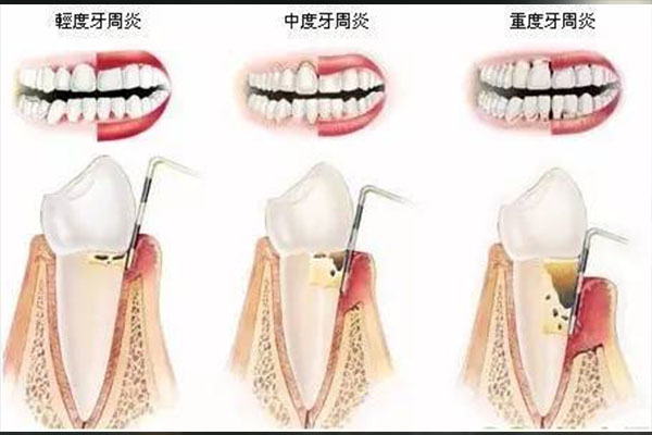 南京治疗牙周炎的医院排名榜(南京治疗牙周炎的医院排名榜最新