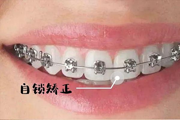 龅牙张嘴呼吸怎么办(龅牙和张嘴呼吸