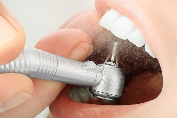 北京洗牙要多少钱一次(北京洗牙要多