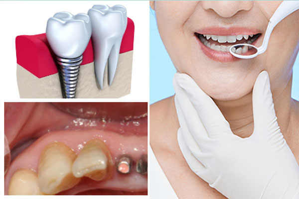 北京种植牙齿多少钱一颗医保(北京种