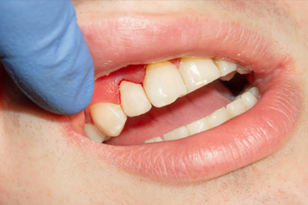 牙齿黑色素沉淀的原因有哪些呢吃什