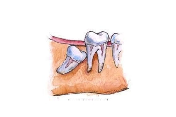 复杂智齿拔除费用大概多少(复杂智齿