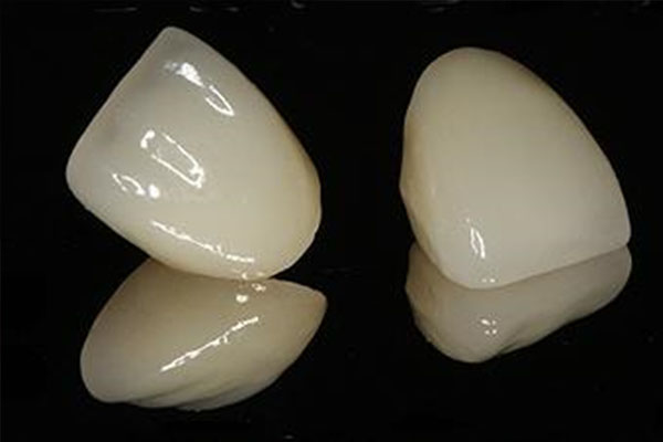 牙贴面制作周期得多久啊多少钱一颗