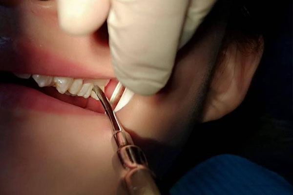 多颗牙齿脱落(多颗牙齿脱落是什么原