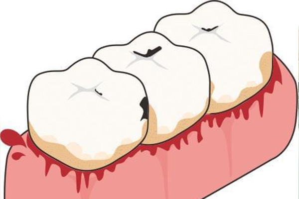 刷牙天天出血正常吗女人