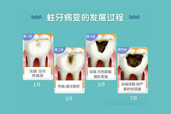 严重的龋齿是拔还是补(严重的龋齿是