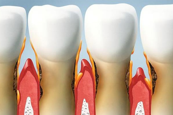 喝茶牙齿黄了(喝茶牙齿黄了能恢复吗)