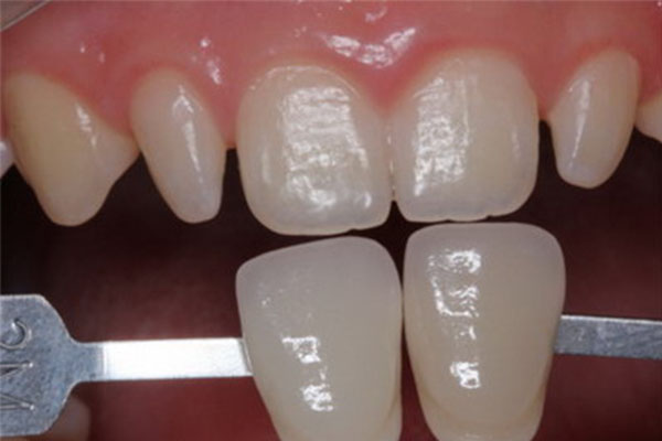 牙贴树脂贴面的优缺点(牙贴树脂贴面的优缺点是什么)