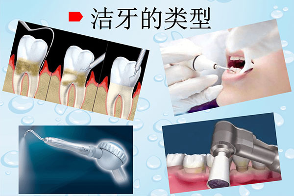 洁牙效果怎么样(洁牙效果怎么样知乎)