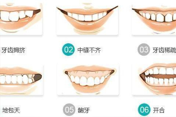 龅牙很影响颜值吗(龅牙会影响美观吗