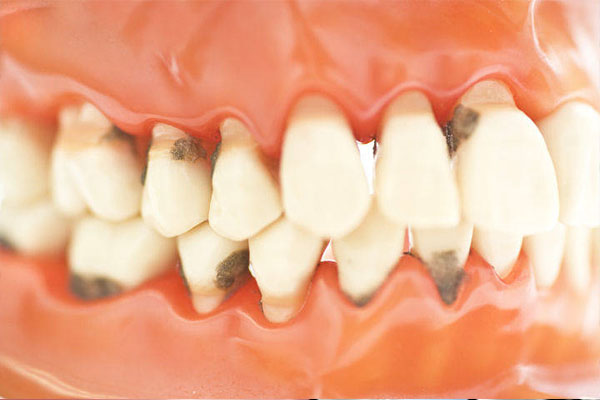 地包天带矫正器吃完饭要洗吗(带地包