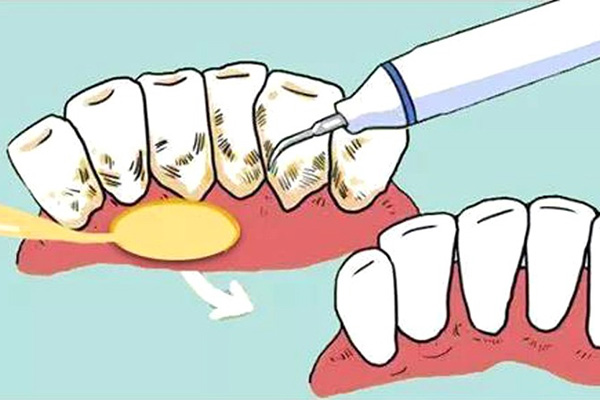 洁牙抛光的好处是什么(洁牙抛光的好