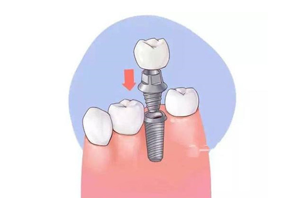 三明市第一医院种牙新选择：批量高
