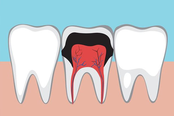 牙齿经常蛀牙是缺钙吗怎么办