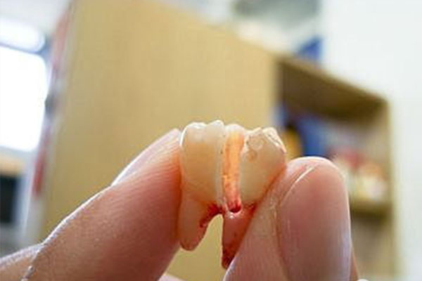 交大一附院拔智齿价格揭秘 中老年口