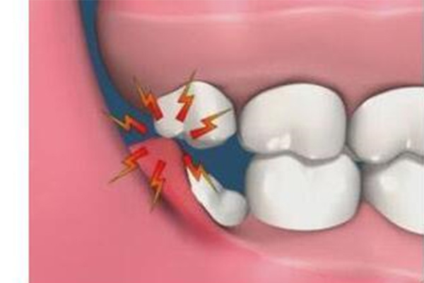 智齿发炎肿痛牙龈红肿怎么办吃什么