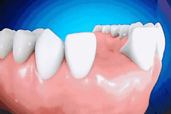 中老年口腔专家：如何预防牙齿脱落