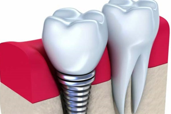 北京种牙可以报销了吗 医保能报销吗