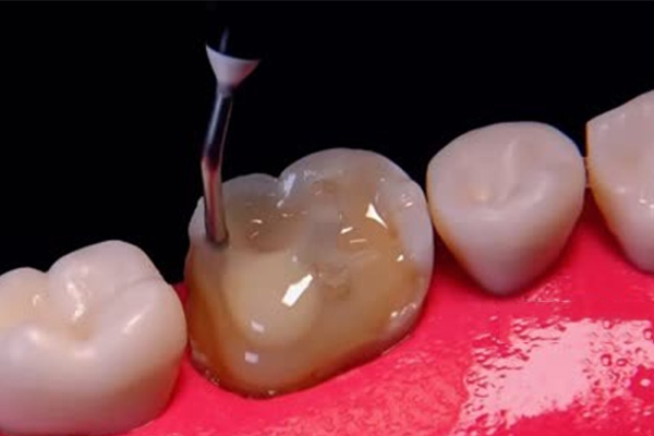 9岁孩子牙齿蛀牙怎么办？家长必看的3个科学处理方案