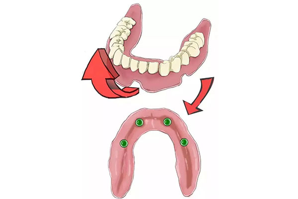 种牙二期和一期哪个疼些