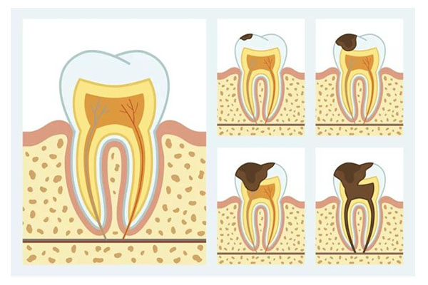 孩子14岁出现蛀牙怎么办？中老年口腔