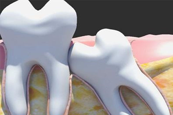 中老年口腔：上智齿酸痛可能是蛀牙，一招教你快速判断与处理