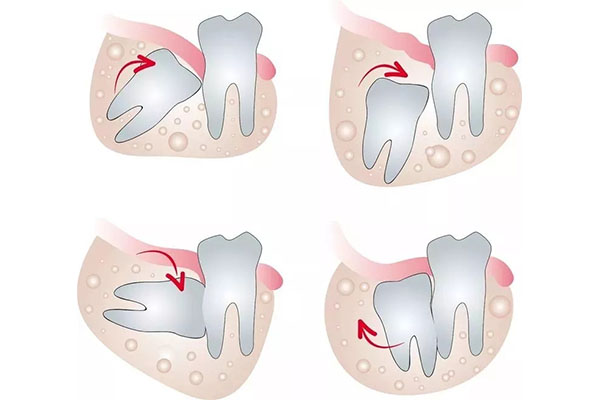 拔颗智齿大概要多少钱一颗？中老年