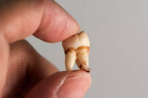 拔一颗智齿后多久能恢复正常？中老