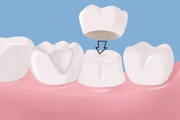 中老年口腔：补牙玻璃离子的舒适选