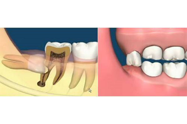 智齿没发炎但磨肉严重？中老年口腔
