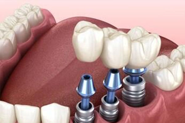 种牙还是烤瓷牙？中老年口腔帮你选对修复方式