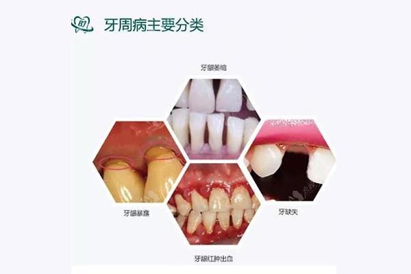 慢性牙周炎早期症状及治疗方案，中