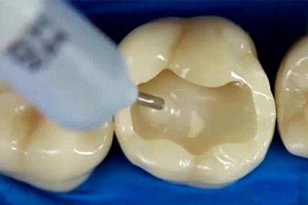 补牙什么树脂材料最好最结实？中老