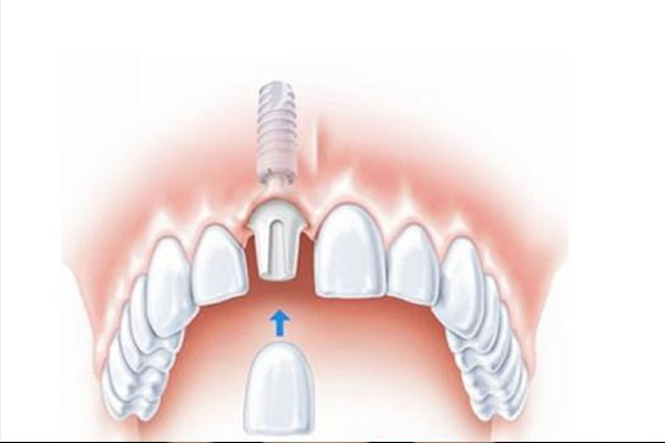 昆山种牙哪里最好的医生呢
