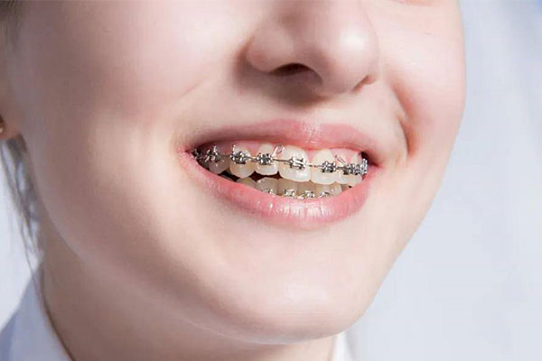 成年正畸需要多久？中老年口腔专家为您解读高效解决方案