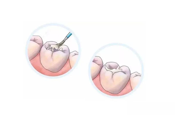 为什么一定要给孩子涂氟？中老年口