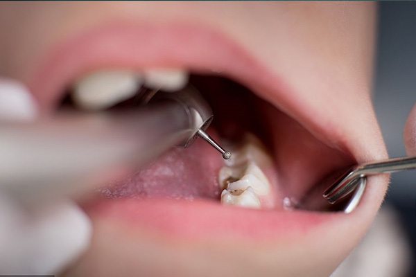 中老年缺牙患者用盐水漱口会怎么样