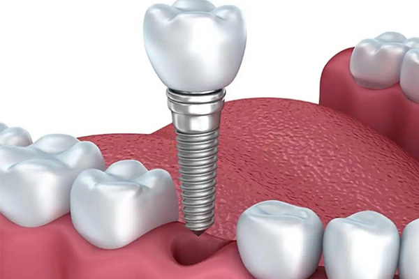 北京种牙能走医保吗？最新政策解读及解决方案