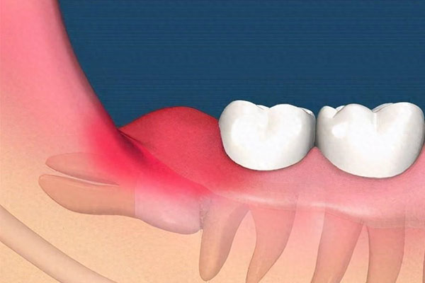 拔智齿疼几天？中老年口腔专家告诉你！