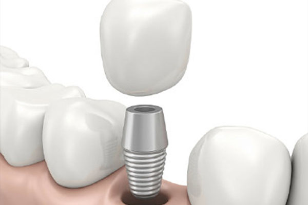 中老年种牙价格大揭秘：一颗牙多少钱？批量种牙更划算