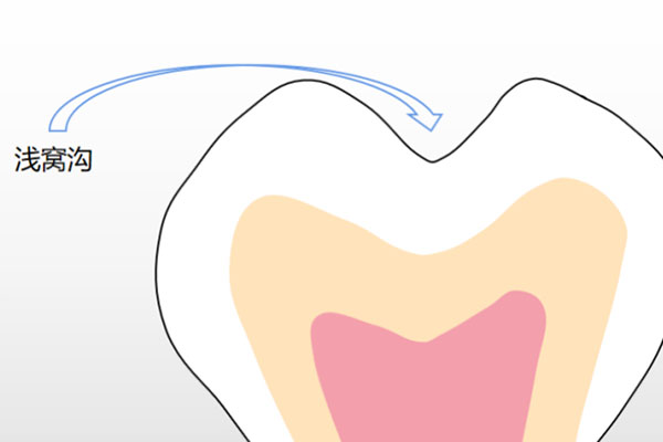 孩子几岁开始涂氟最有效？中老年口腔专家建议这样做！