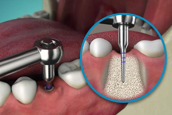 揭秘种牙寿命：中老年口腔专家为您