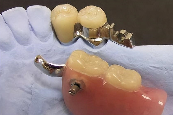 镶活动假牙价格是多少？中老年口腔