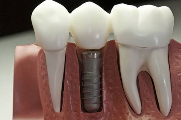 拔牙后还能种牙吗？中老年口腔为您