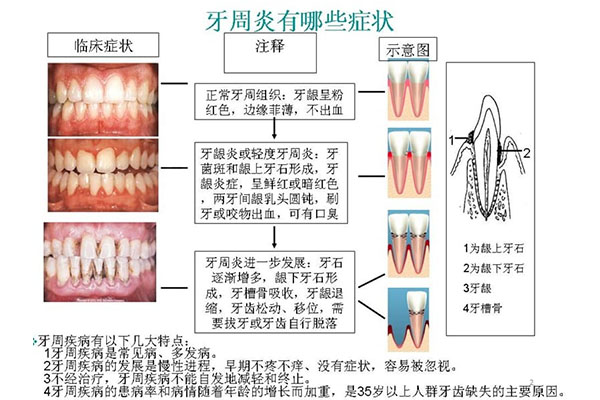 慢性牙周炎临床分度及表现：中老年口腔专家揭秘牙龈出血、牙