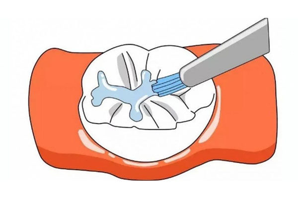 牙齿涂氟的正确方法，中老年口腔为