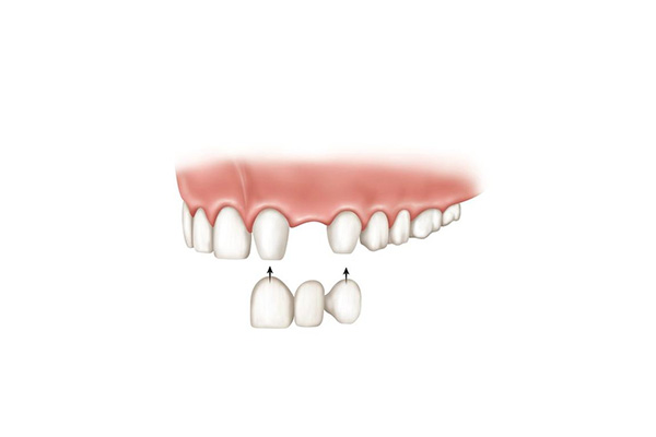 老人镶牙多少钱一套？中老年口腔为您揭秘真相！